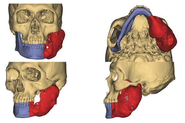 Восстановление челюстной кости с помощью 3D-технологии